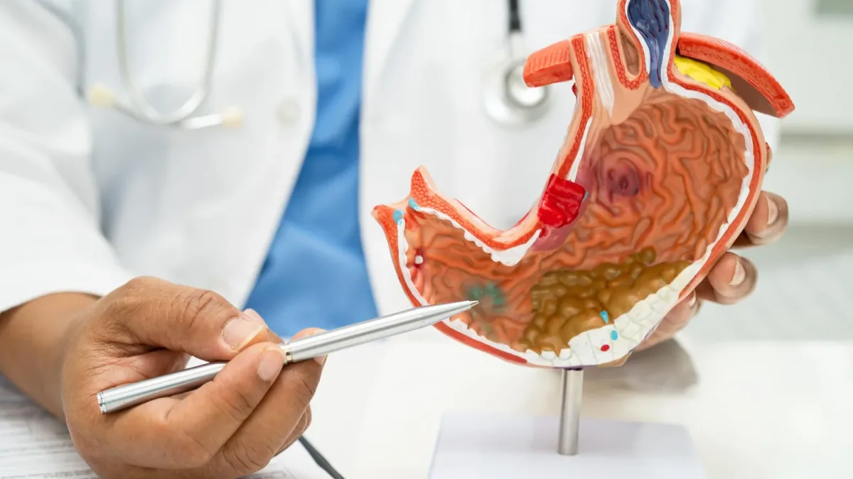 Cancer de l’estomac : par quel mécanisme une bactérie explique trois cas sur quatre