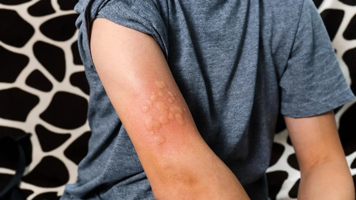 Démangeaisons masculines Réaction allergique Peau sensible Symptômes d'allergie alimentaire Irritation